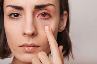 Akutní zánět oční rohovky není banalita. Bez léčby může poškodit zrak! Poznejte příznaky včas - Proženy.cz